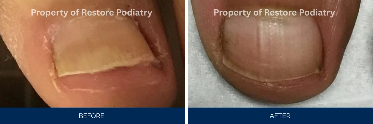 Before and after toenail fungus treatment showing discolored nail becoming clear and healthy