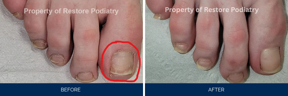 Before and after toenail fungus treatment with affected nail circled in red, showing improvement to clear nail