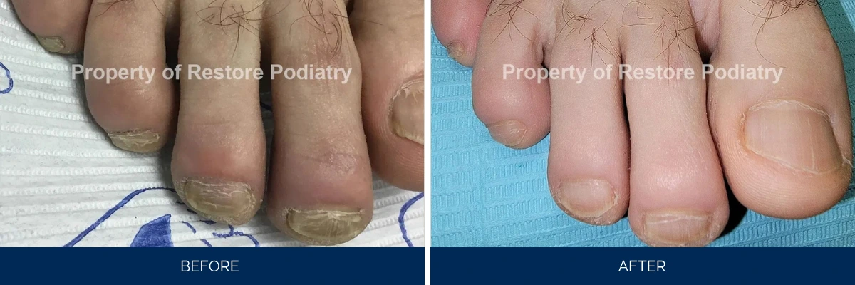 Before and after toenail fungus treatment comparison showing discolored nails before and clear nails after