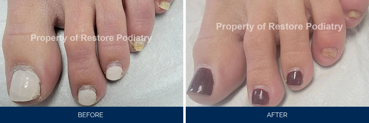 Before and after toenail fungus treatment showing white-clouded nails becoming clear with healthy appearance
