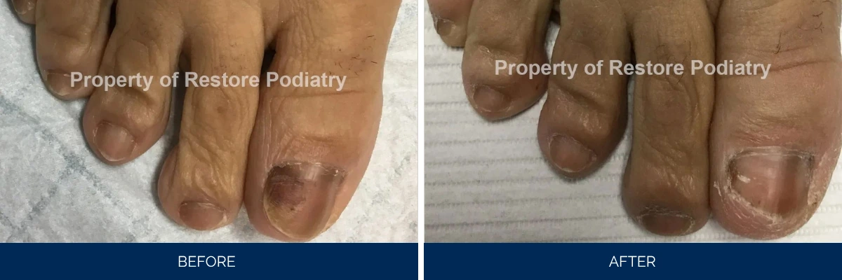 Before and after toenail fungus treatment on darker skin tone showing darkened nails becoming clearer