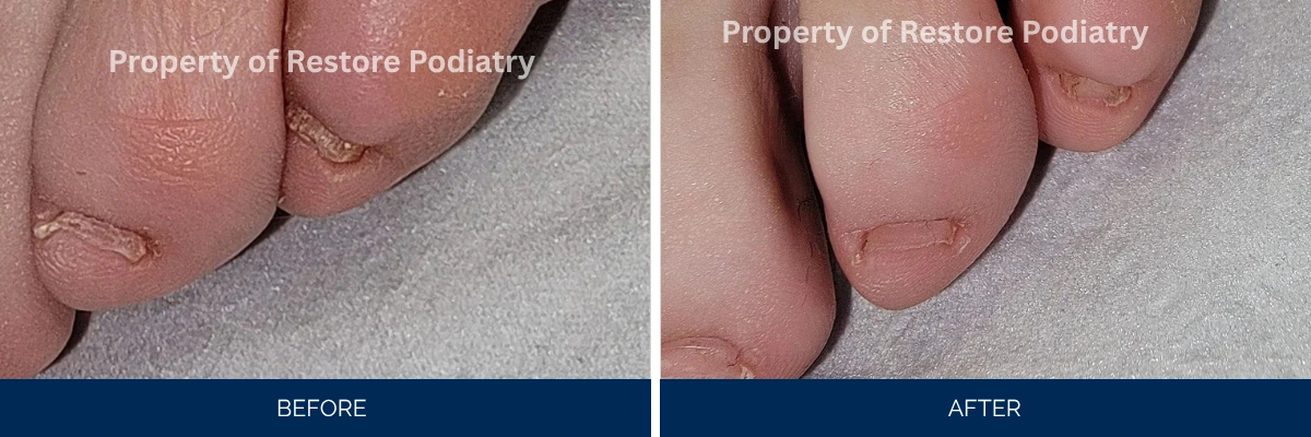Before and after toenail fungus treatment showing damaged nails with improved clarity and appearance