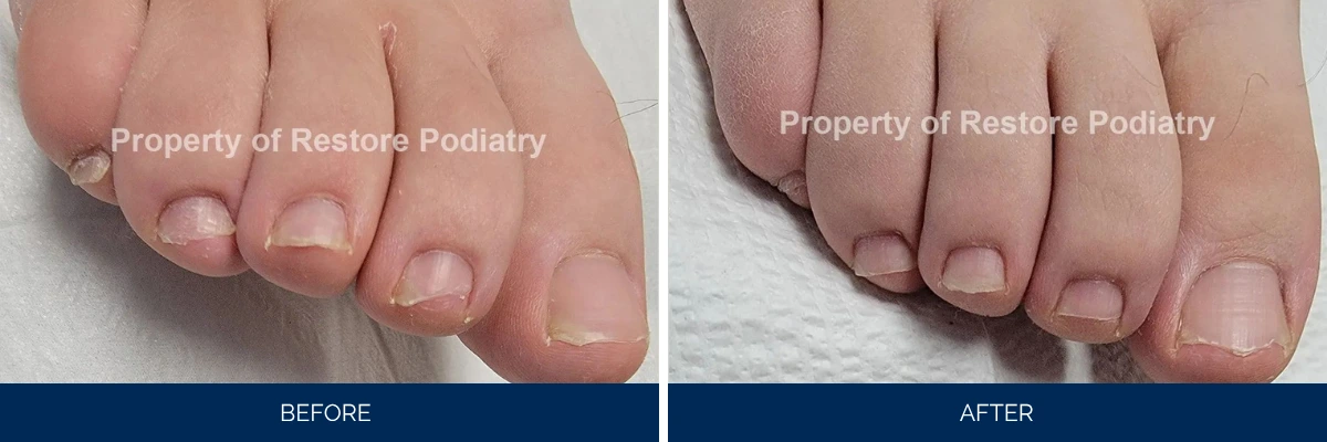 Before and after toenail fungus treatment showing nails with discoloration becoming clear and healthy-looking