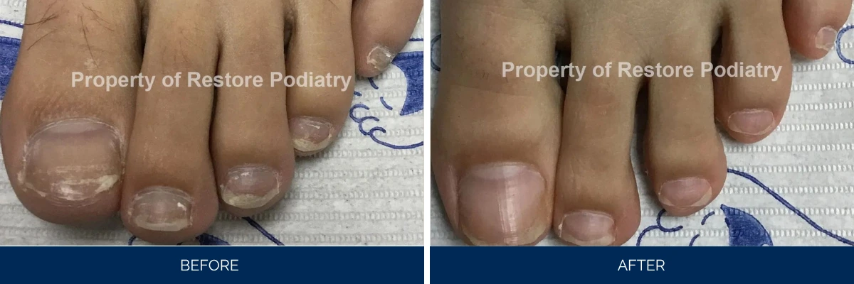 Before and after toenail fungus treatment showing discolored, thickened nails improving to clear healthy nails