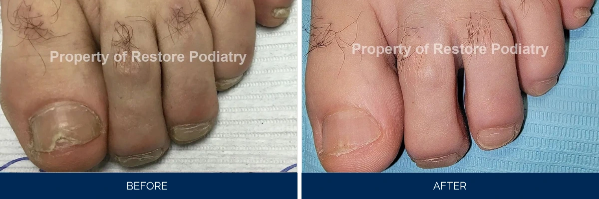 Before and after toenail fungus treatment showing infected nails with discoloration clearing to normal appearance