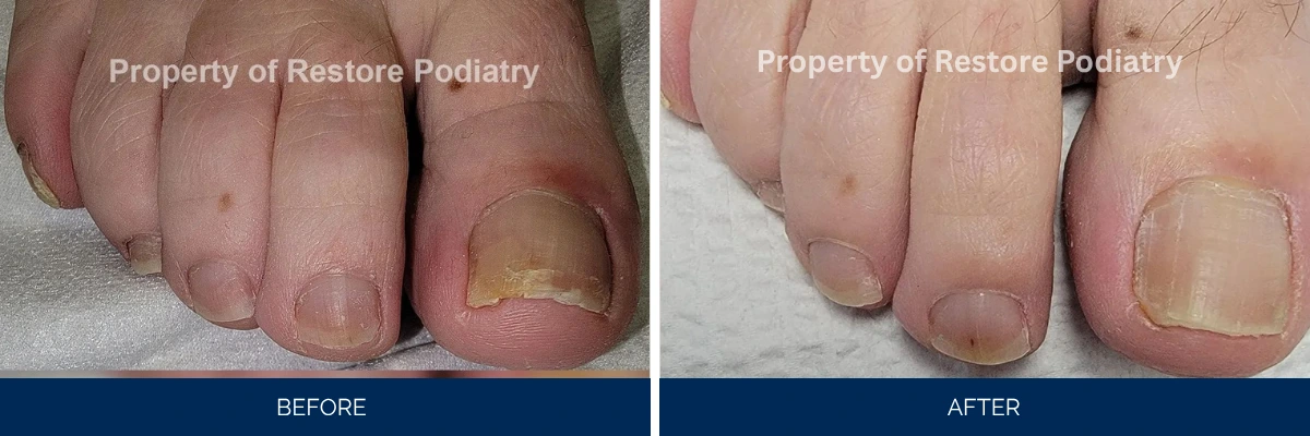 Before and after toenail fungus treatment showing thick yellow nail improving to clear healthy nail