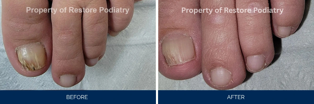 Before and after toenail fungus treatment showing infected nail with yellow discoloration resolving to clear nail