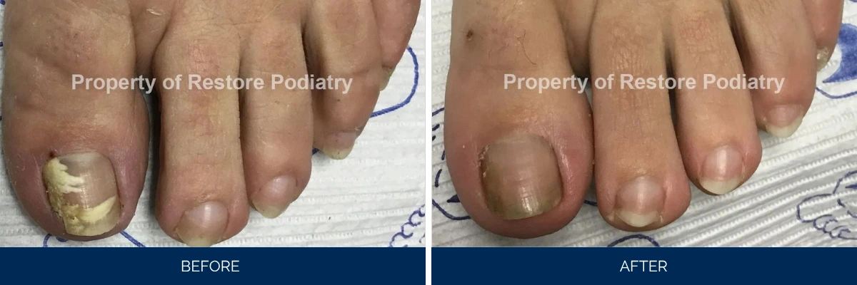 Before and after toenail fungus treatment showing thick discolored nail improving to normal healthy appearance
