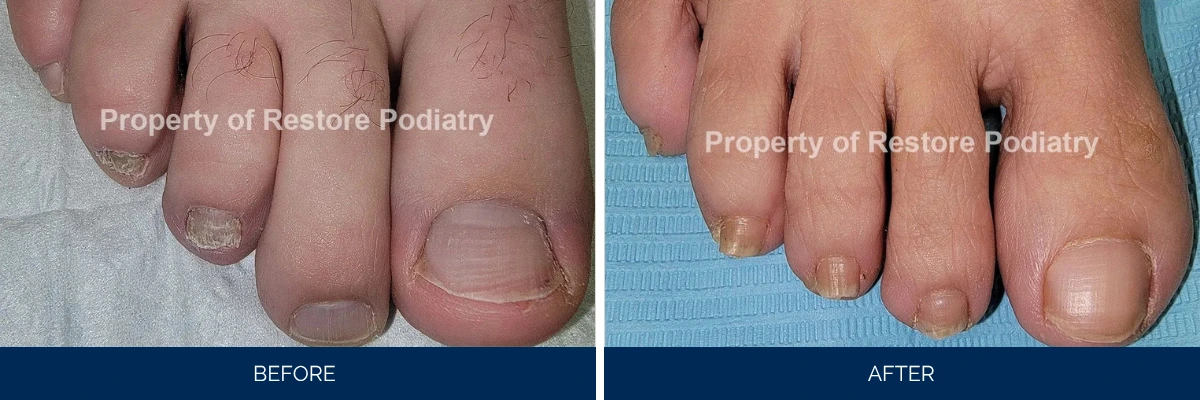 Before and after toenail fungus treatment showing infected nails with white discoloration clearing to healthy nails