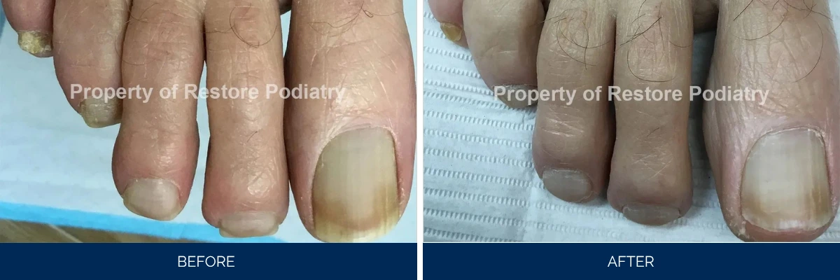 Toenail fungus case 44: before and after treatment showing infected toenail with discoloration clearing to healthy nail