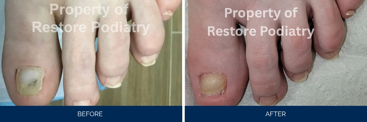 Toenail fungus case 45: before and after treatment showing fungal infection resolving to clear toenail