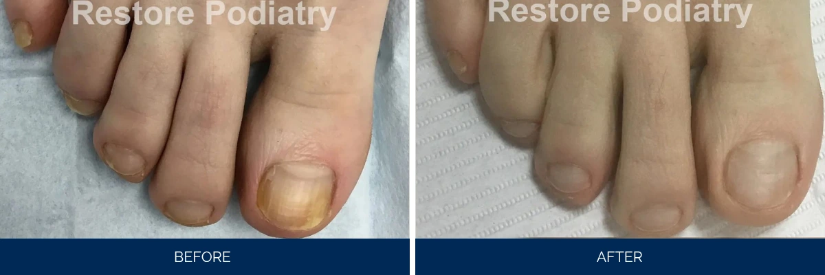 Toenail fungus case 46: before and after treatment showing damaged toenail becoming clear and normal