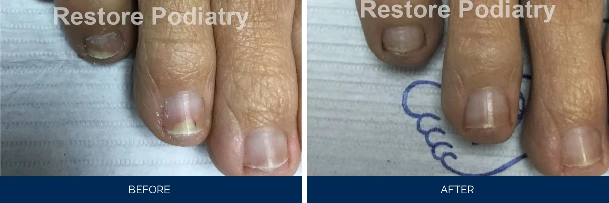 Toenail fungus case 47: before and after treatment showing infected toenail improving to healthy appearance