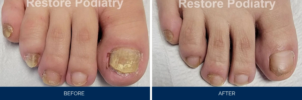 Toenail fungus case 48: before and after treatment showing multiple infected toenails clearing to healthy nails