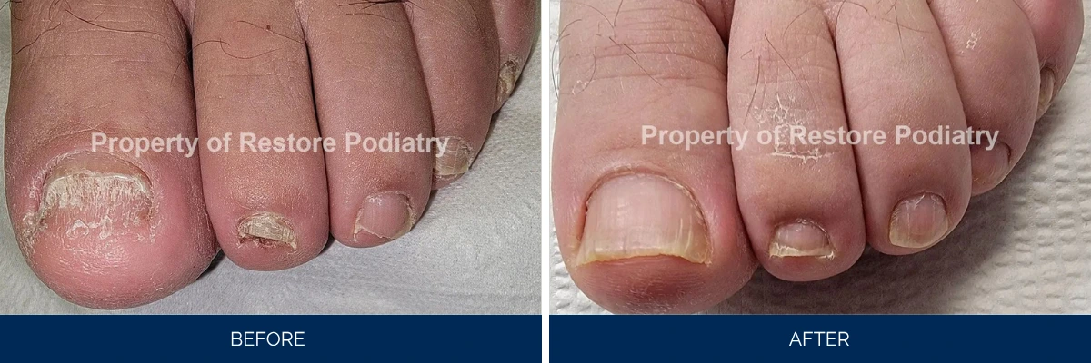 Toenail fungus case 49: before and after treatment showing severe fungal infection resolving to clear toenails