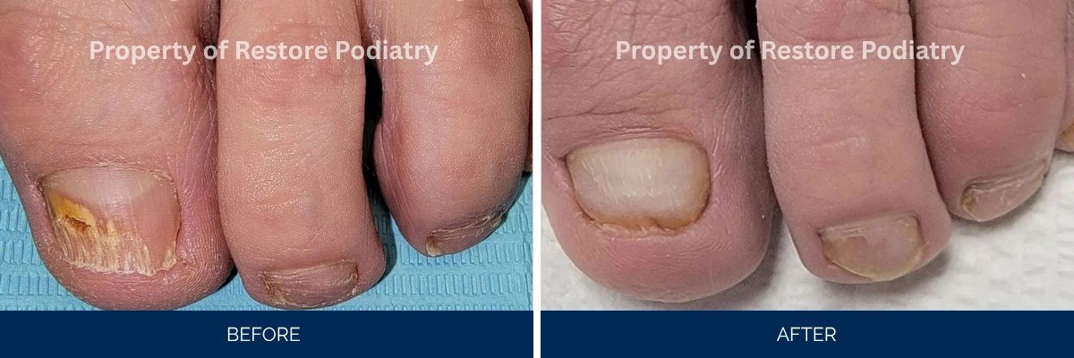Before and after comparison of toenail fungus treatment showing discolored infected nails on left and clear healthy nails on right