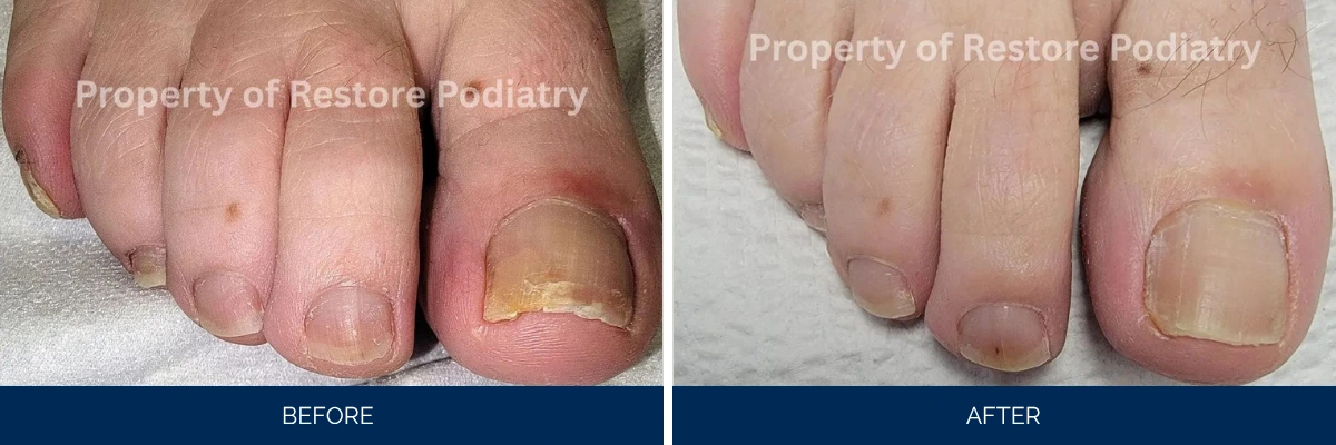 Before and after toenail fungus treatment showing yellowed nails before and healthy nails after