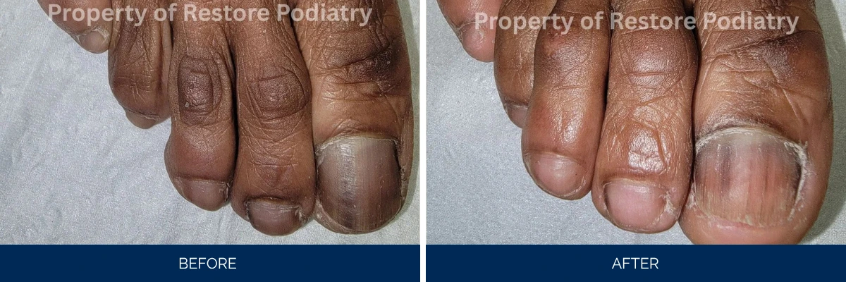 Before and after comparison of toenail fungus treatment showing thick discolored nails on left and restored clear nails on right