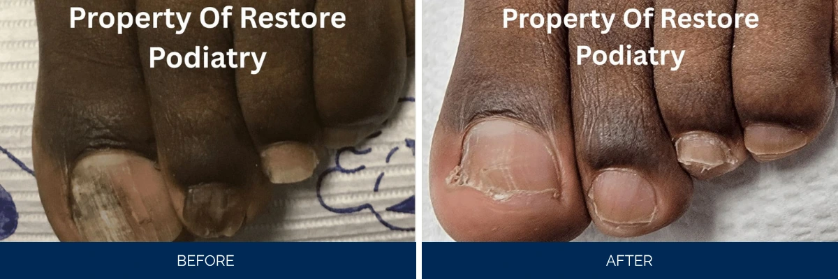 Before and after comparison of toenail fungus treatment showing darkened infected nails on left and clarified nails on right