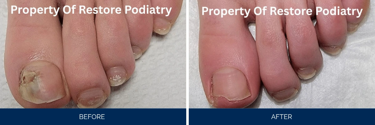 Before and after comparison of toenail fungus treatment showing yellowed brittle nails on left and restored healthy nails on right