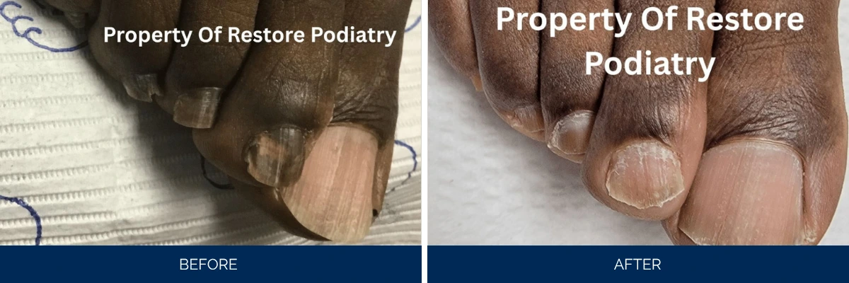 Before and after comparison of toenail fungus treatment showing darkened thickened nails on left and cleared nails on right