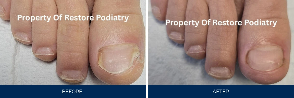 Before and after comparison of toenail fungus treatment showing yellowed infected nail on left and restored clear nail on right