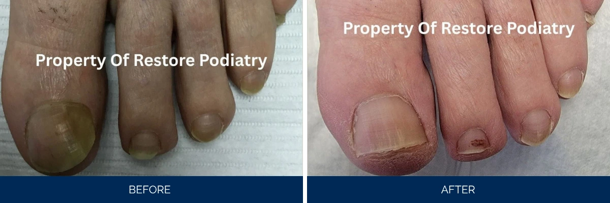 Before and after toenail fungus treatment showing darkened nails transforming to clear healthy nails