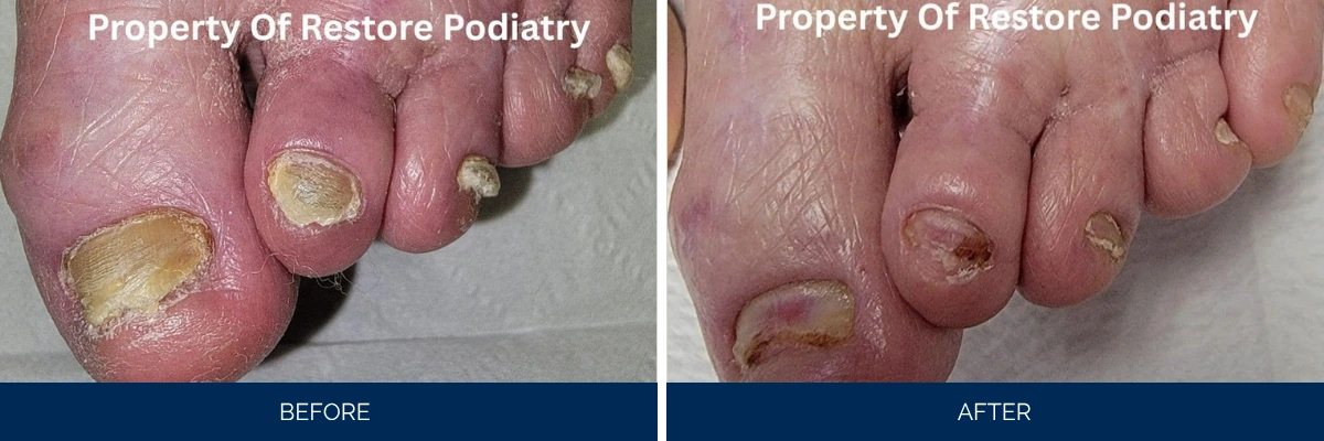 Before and after toenail fungus case showing thick discolored nails healing to smooth pink nails