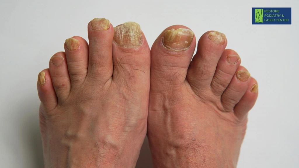 Top view of feet with multiple toenails affected by fungus showing yellowing and thickening