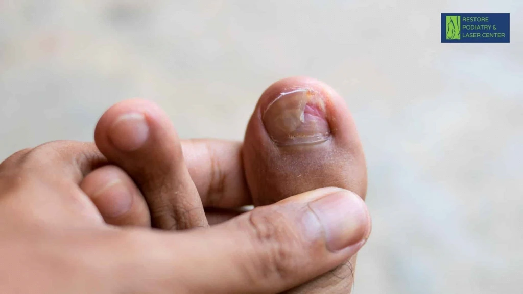 Close-up of toenail with fungal infection showing discoloration and nail damage