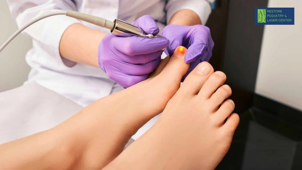 Podiatrist in purple gloves using laser device to treat toenail fungus on patient's foot
