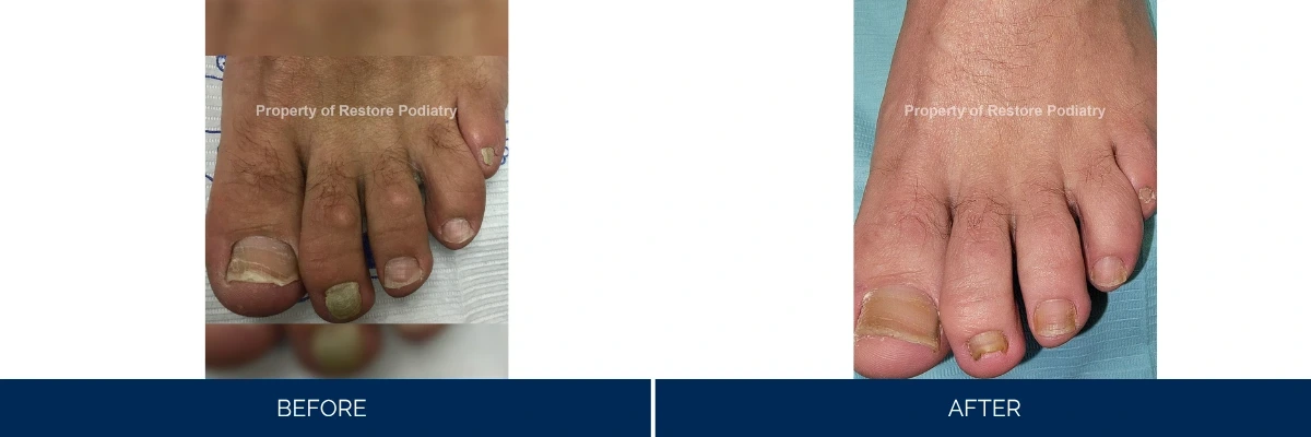 Before: foot with discolored, thickened toenails showing fungal infection