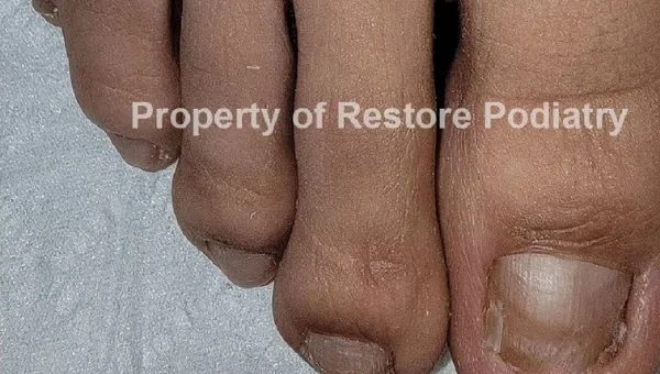 Toenail fungus Case 1 after — 5 years