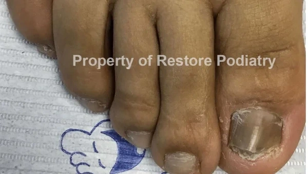 Toenail fungus Case 1 before — 5 years