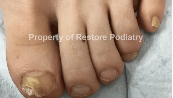 Toenail fungus Case 3 before — 3 years