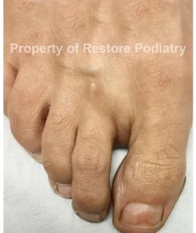 Toenail fungus Case 4 after — 5 years