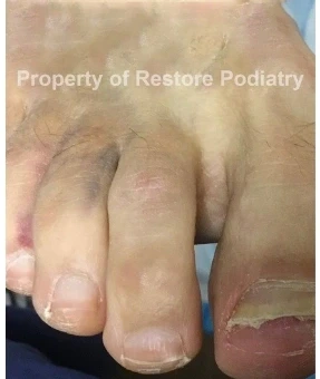 Toenail fungus Case 4 before — 5 years