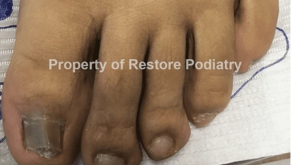 Toenail fungus Case 5 before — 6 years