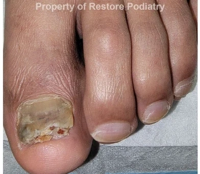 Toenail fungus Case 9 before — 5 years