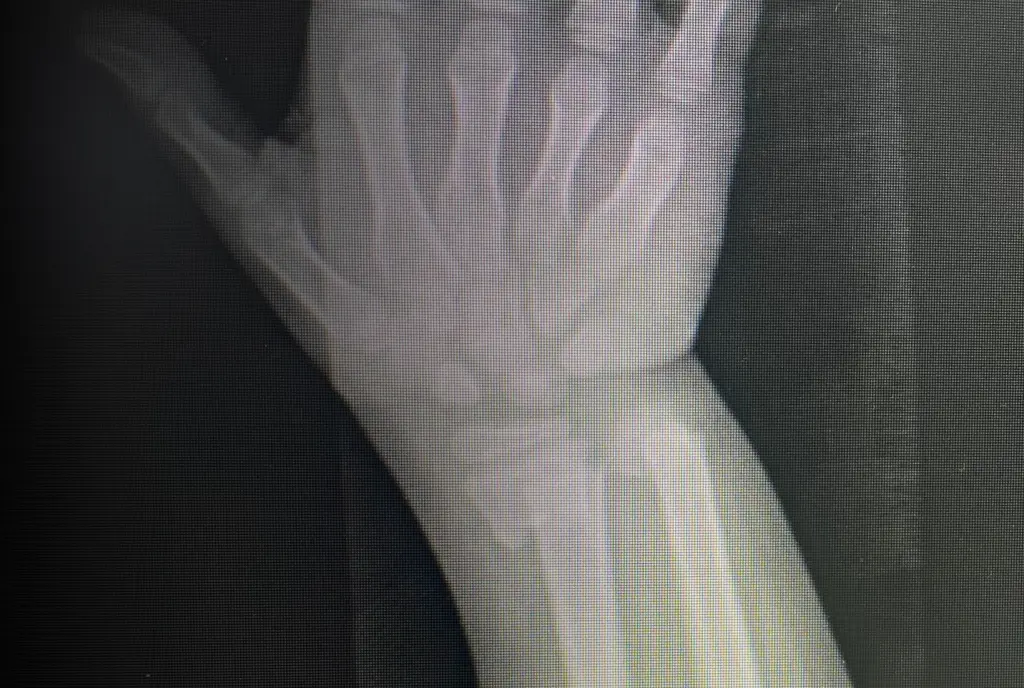 Distal Radial Fractures Treatment Banner