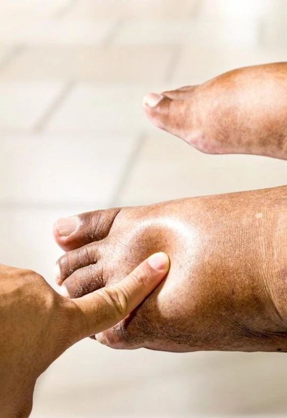 Our Treatments for Diabetic Foot Banner