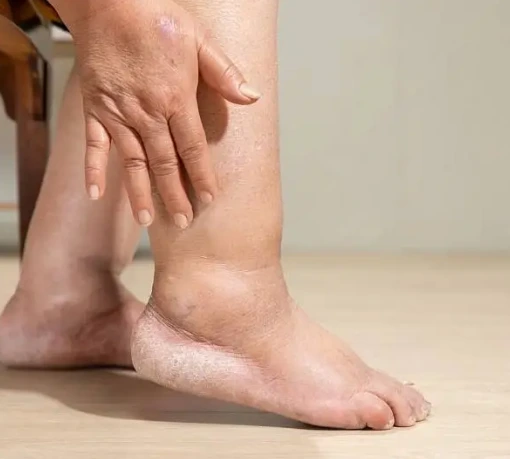 What Is Diabetic Foot? Banner
