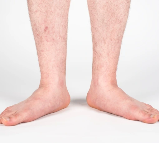 What Is Flat Foot? Banner