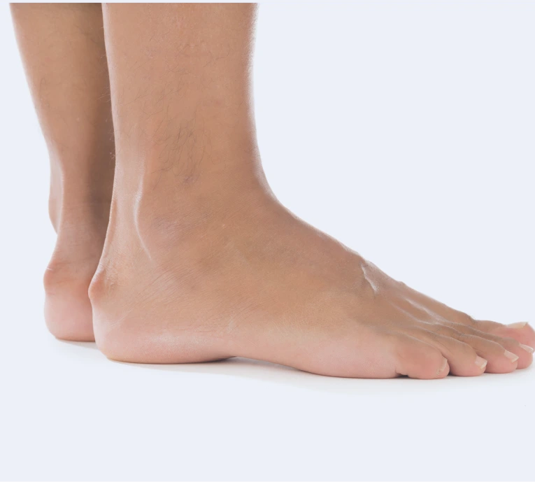 Haglund Deformity Surgery in Miami, FL: What Is Haglund Deformity? Banner