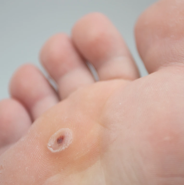 Wart Removal in Miami, FL Banner