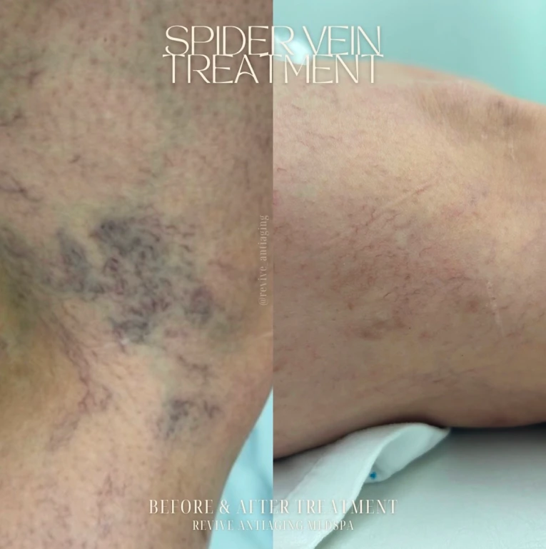 Sclerotherapy in Miami, FL Banner