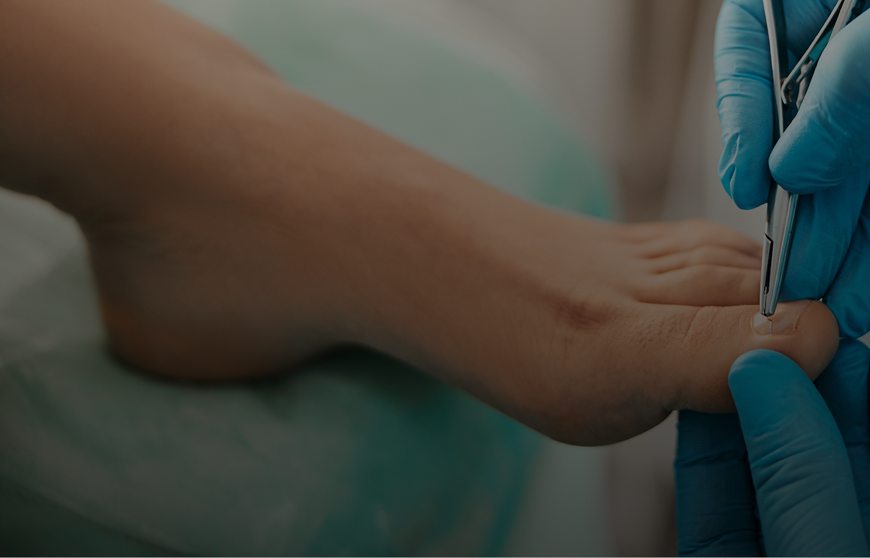Ingrown Nail Treatment in Miami, FL Banner