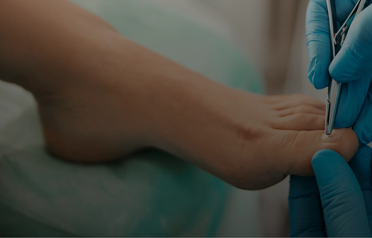 Ingrown Nail Treatment in Miami, FL Banner