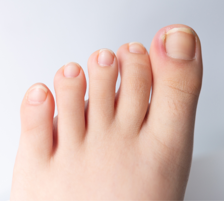 Ingrown Toenail Treatment Miami, FL Banner