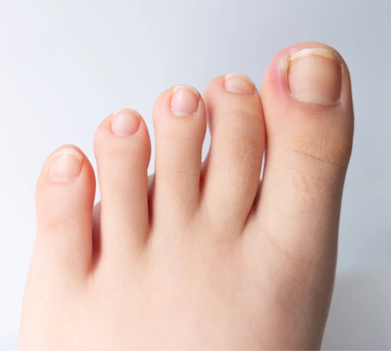 Ingrown Toenail Treatment Miami, FL Banner
